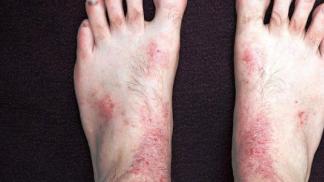 Почему появляется аллергическая сыпь на руках и ногах, и как от нее избавиться