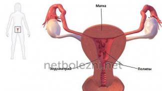 Как проявляется полип эндометрия в матке