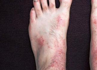 Почему появляется аллергическая сыпь на руках и ногах, и как от нее избавиться