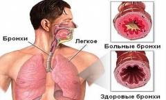 Jenis-jenis patologi paru-paru dan metode perawatannya. Dengan kesehatan, penyakit paru-paru cocok untuk mereka